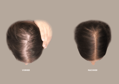 Förderung des Haarwachstums ohne OP