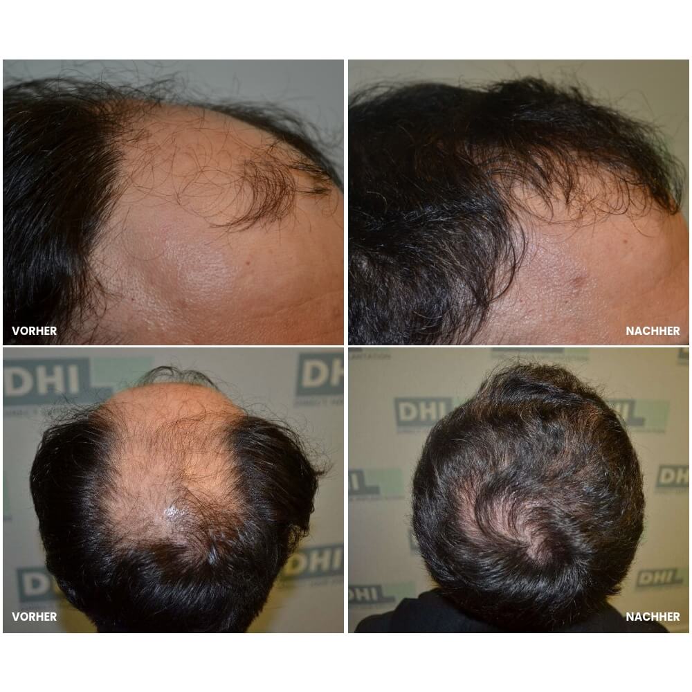 beispiel-haartransplantation