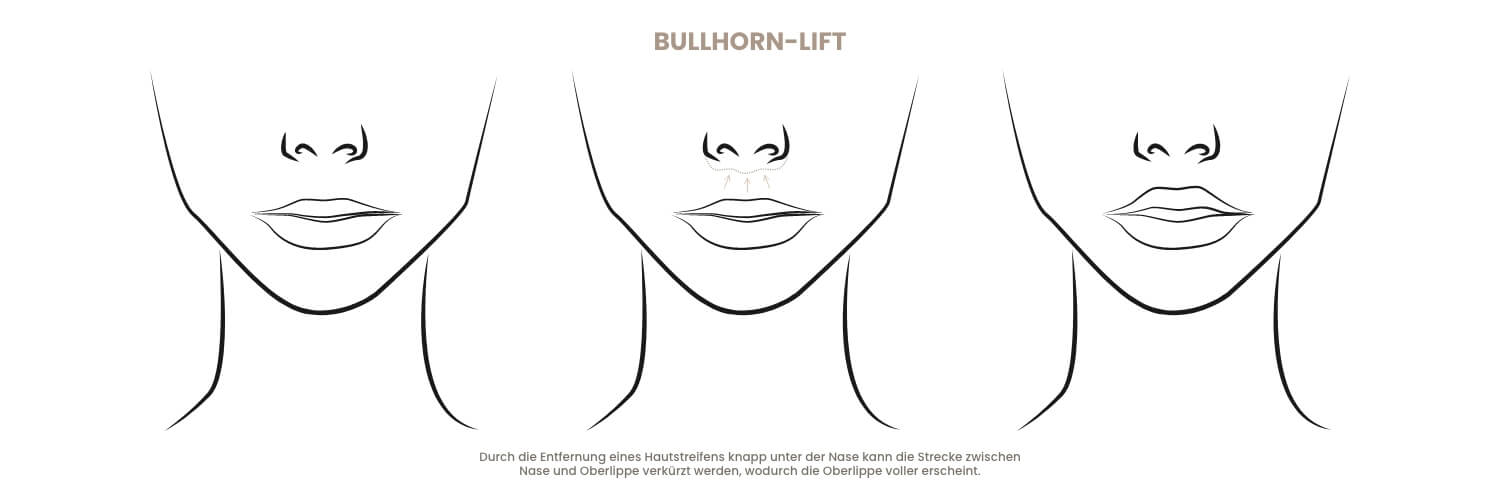 bullhorn-lift-narben-nachsorge