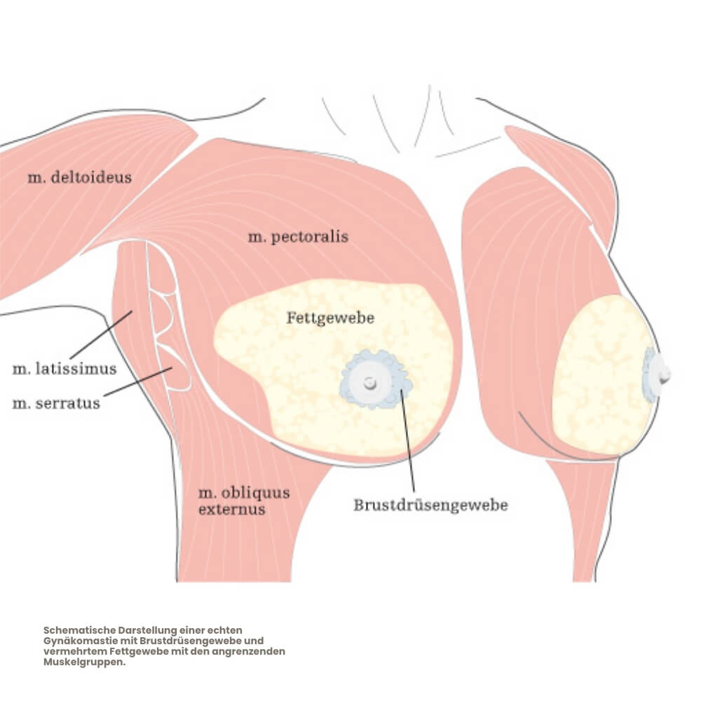 echte-gynaekomastie-mit-brustdruesengewebe-1