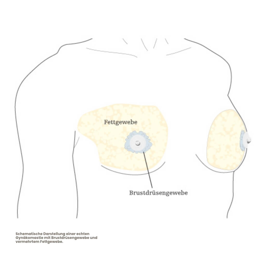 echte-gynaekomastie-mit-brustdruesengewebe-2