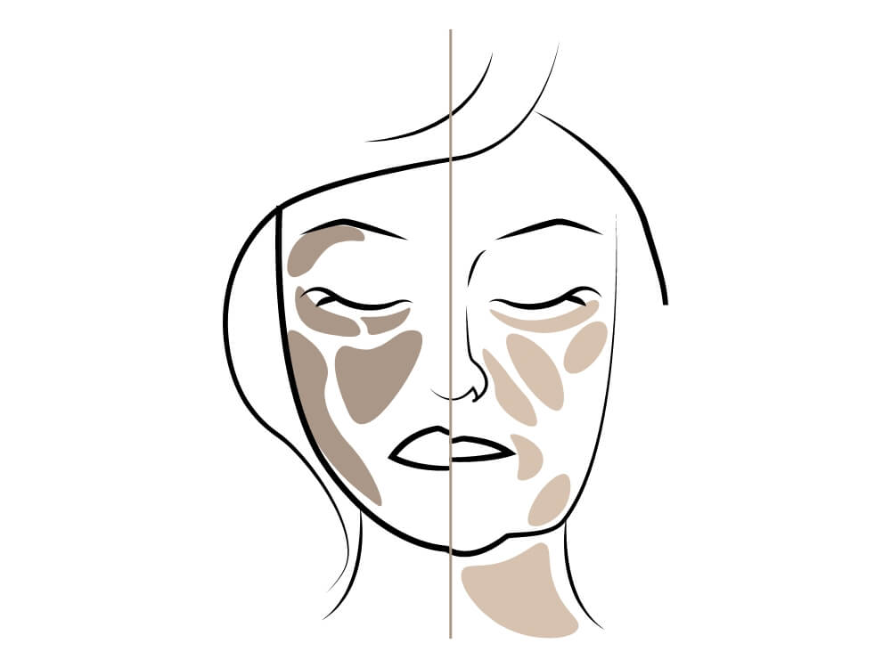 facelift-schema-2