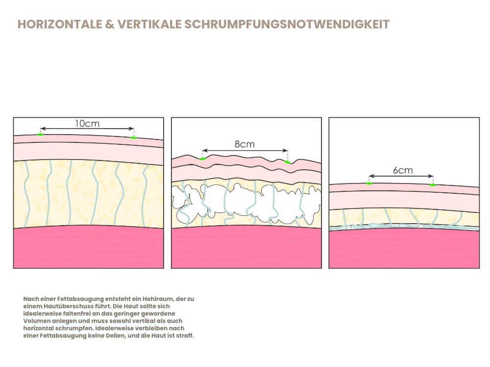 hor-vert-schrumpfungsnotwendigkeit