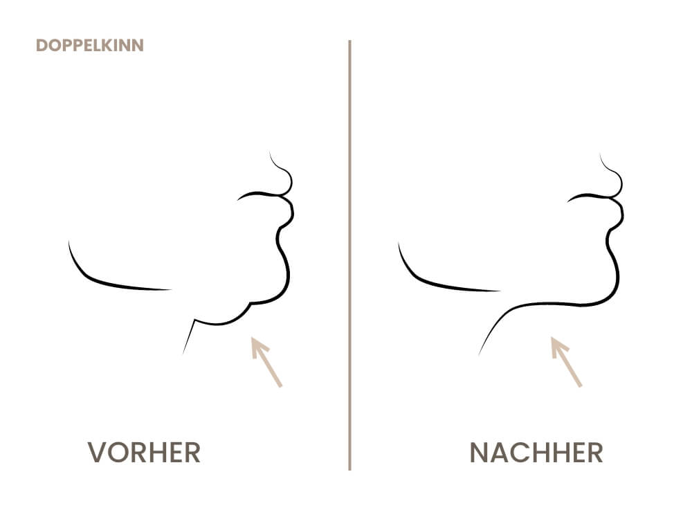 kinnkorrektur-doppelkinn