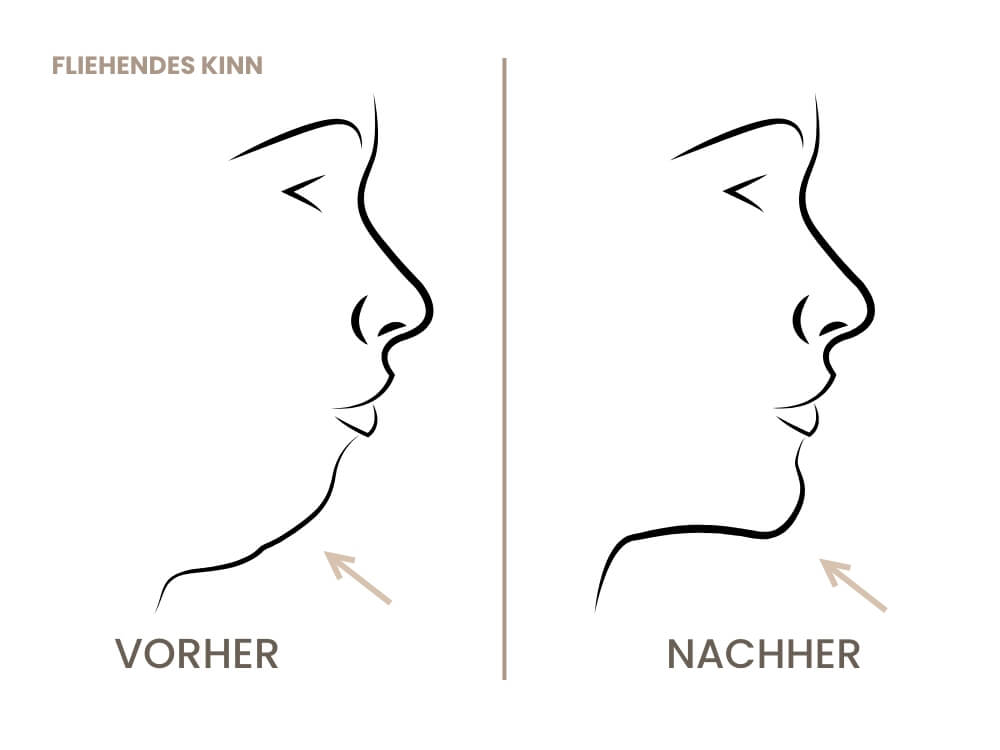 kinnkorrektur-fliehendes-kinn