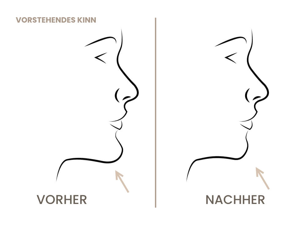 kinnkorrektur-vorstehendes-kinn