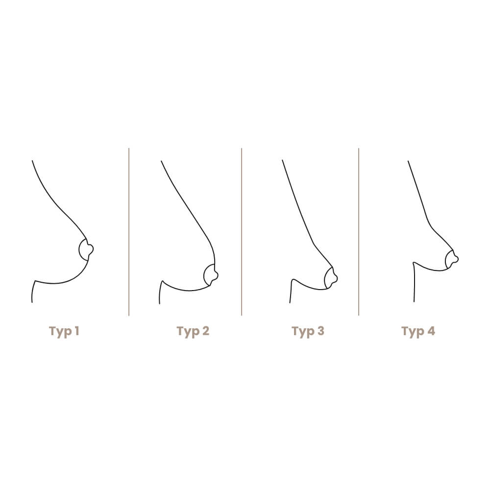 mammatubulaere-deformitaet-typen