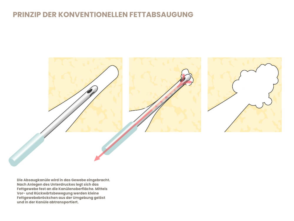 prinzip-der-fettabsaugung
