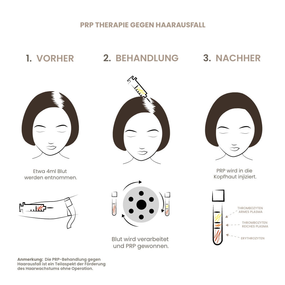 prp-haare-ablauf