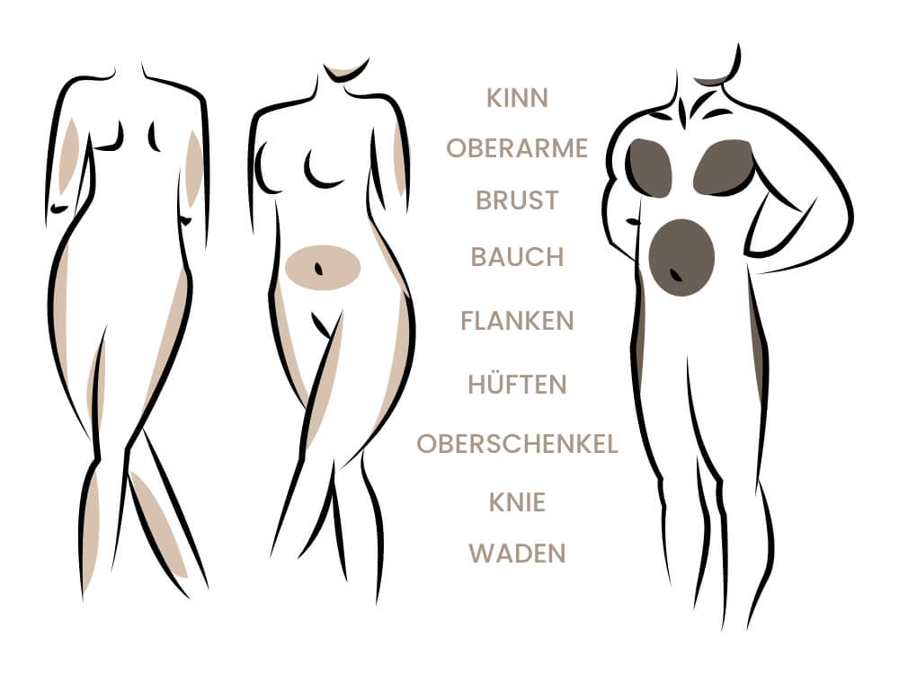 regionen-der-fettabsaugung