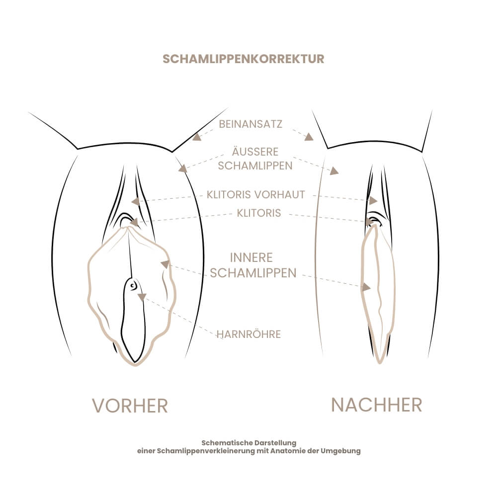 schamlippenkorrektur-schema-1