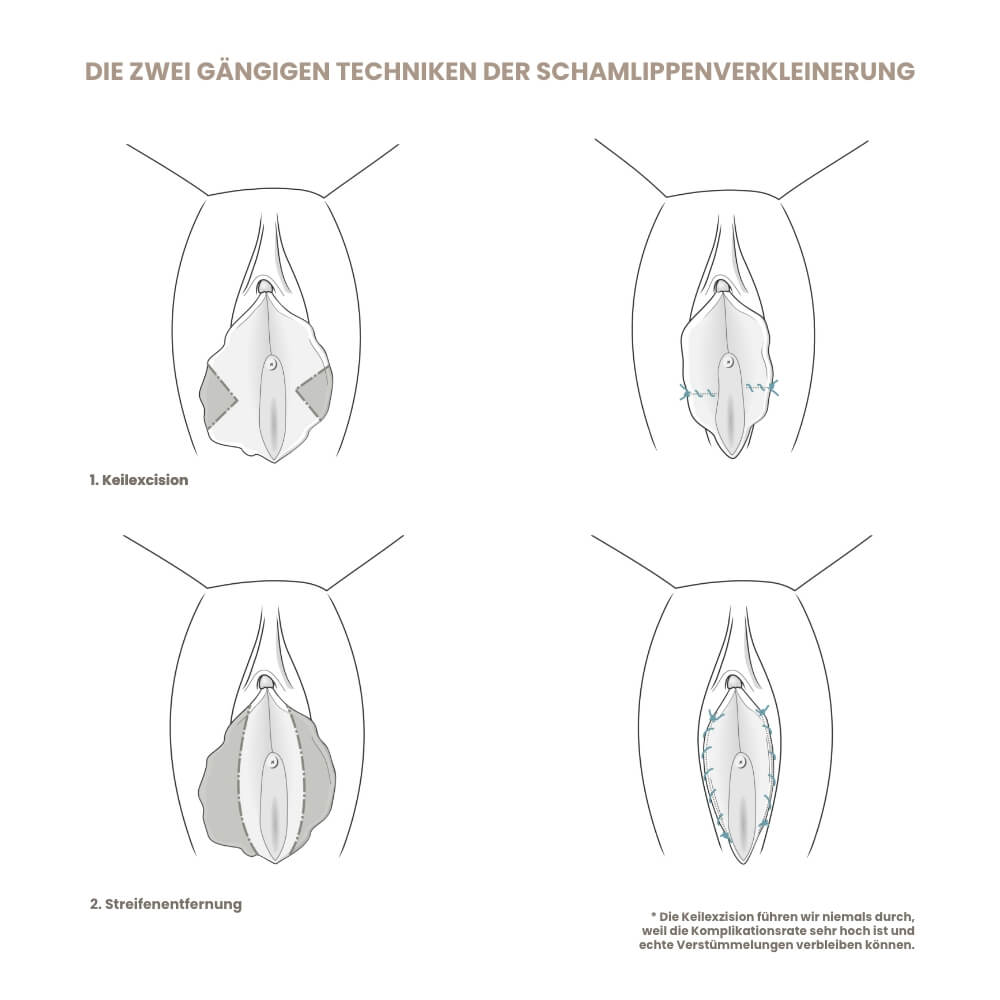 schamlippenkorrektur-schema-2