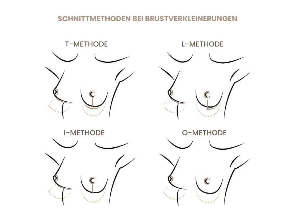 schnittmethoden-brustverkleinerung
