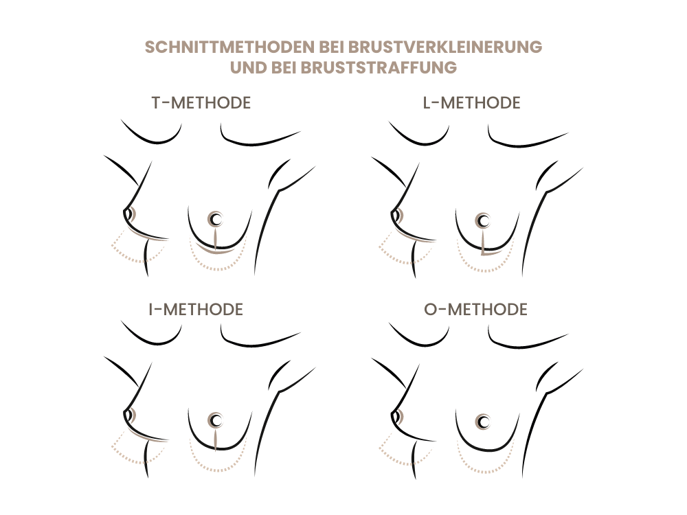 schnitttechniken-bruststraffung
