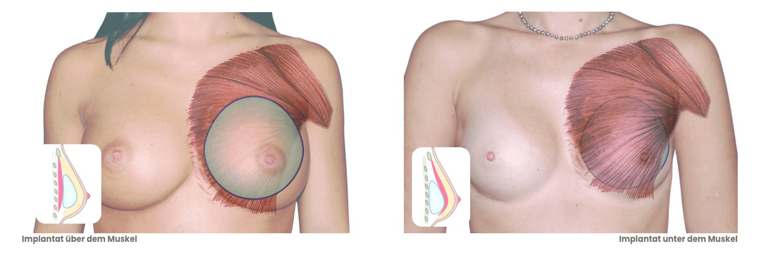 wohin-mit-den-implantaten